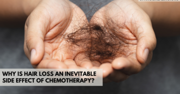 Why is Hair Loss an Inevitable Side Effect of Chemotherapy